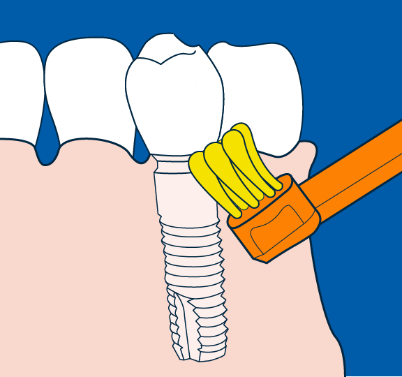 Уход за зубными имплантатами